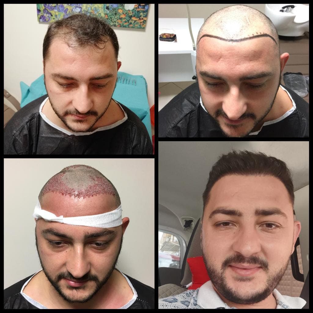 Saç ekimi öncesi ve sonrası — vaka 1