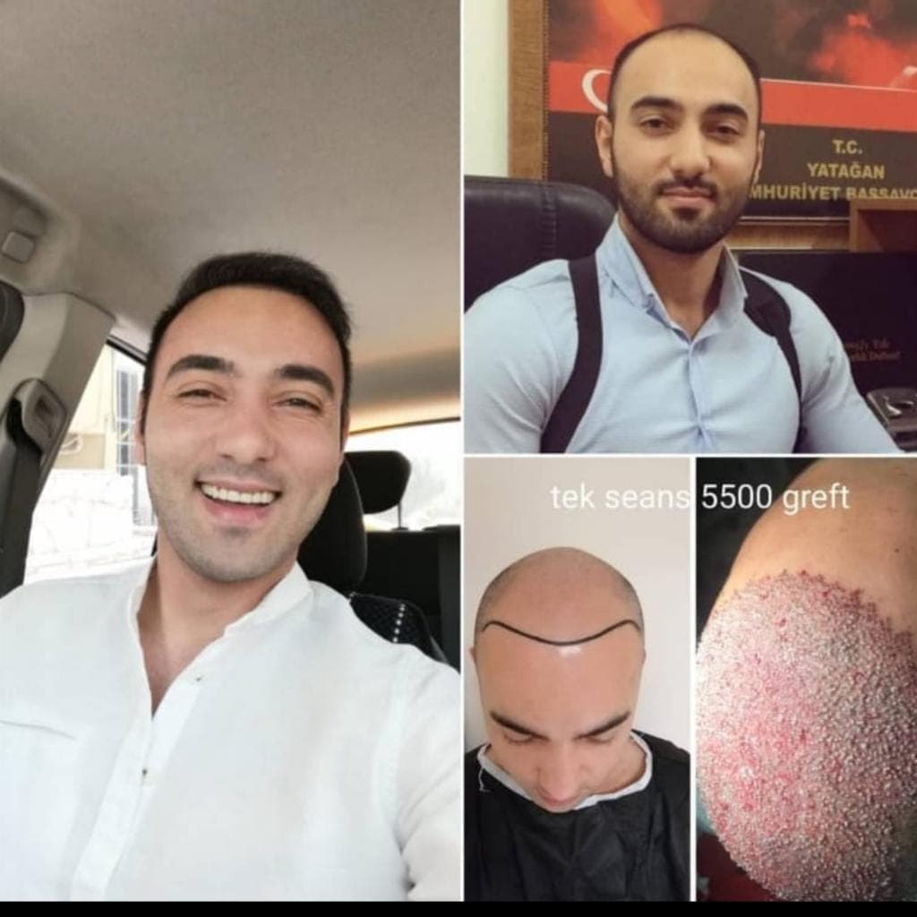 Saç ekimi öncesi ve sonrası — vaka 2