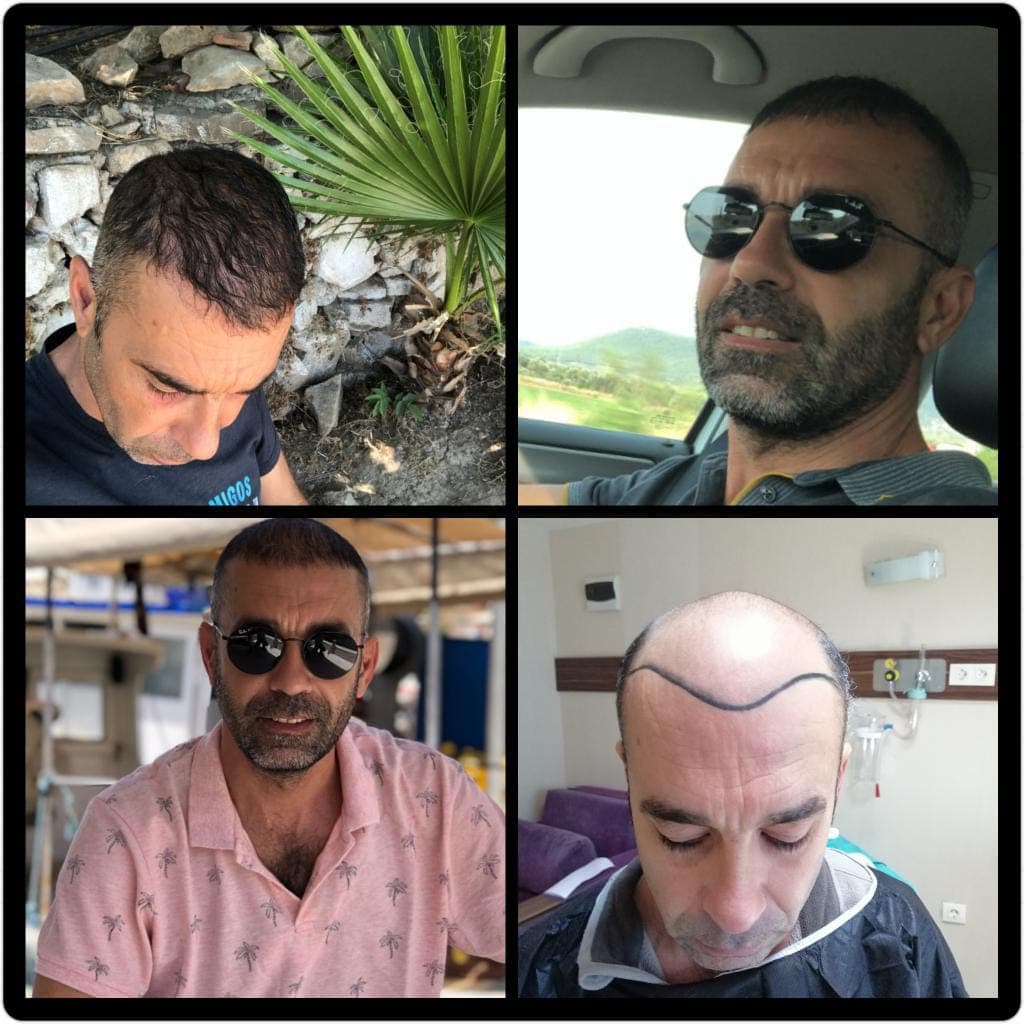 Saç ekimi öncesi ve sonrası — vaka 4