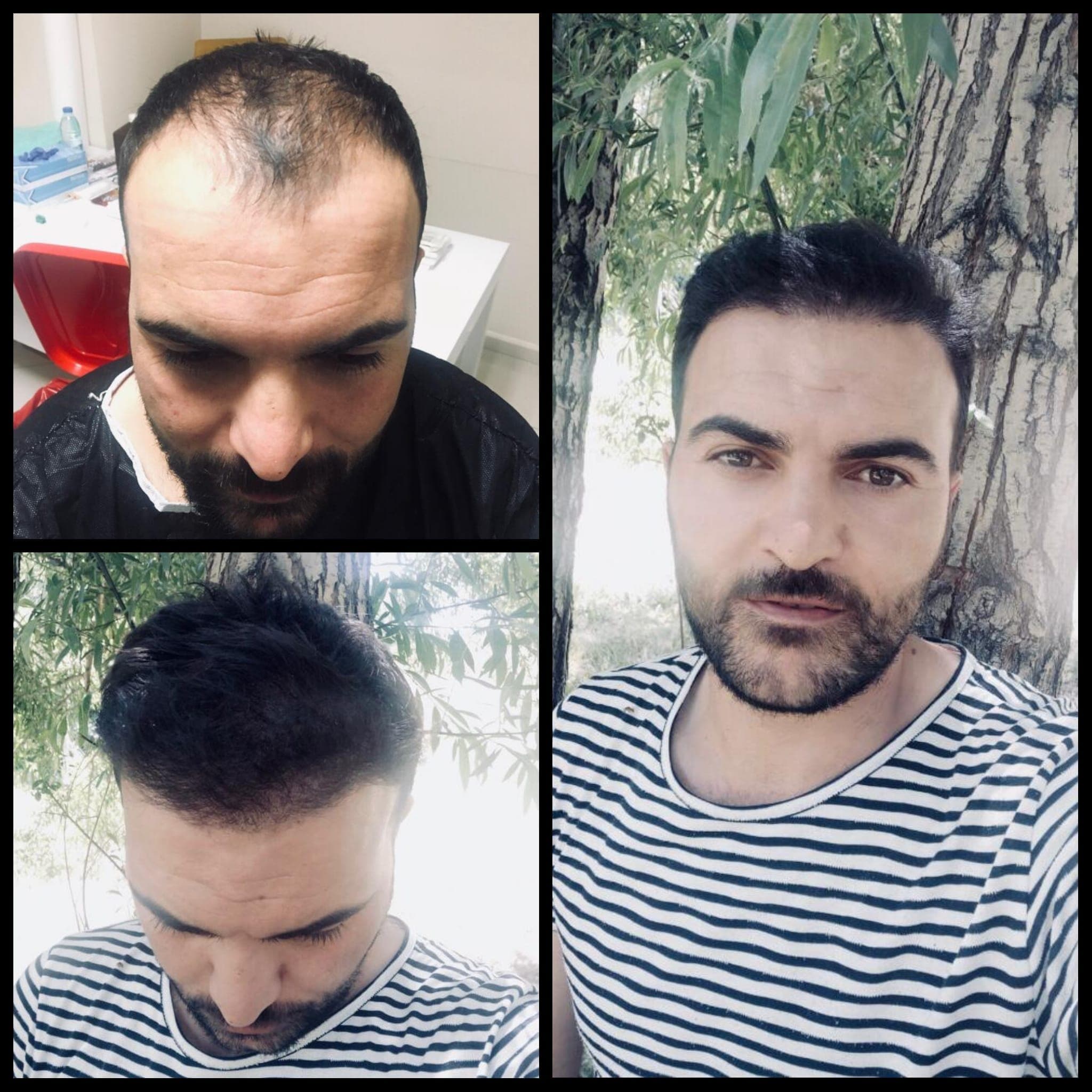 Saç ekimi öncesi ve sonrası — vaka 9