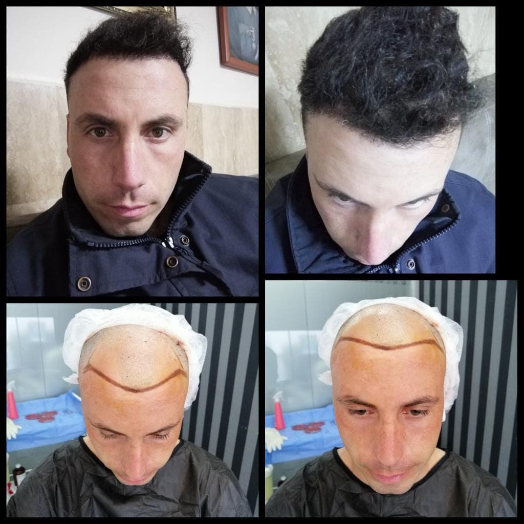 Saç ekimi öncesi ve sonrası — vaka 12