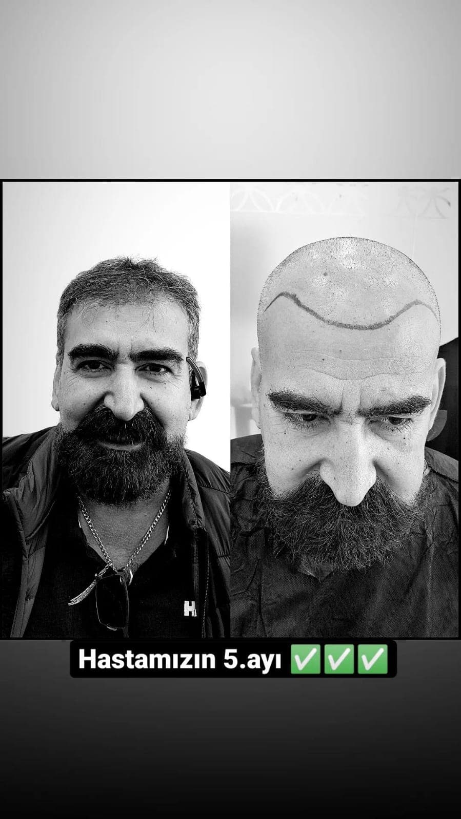 Saç ekimi öncesi ve sonrası — vaka 16