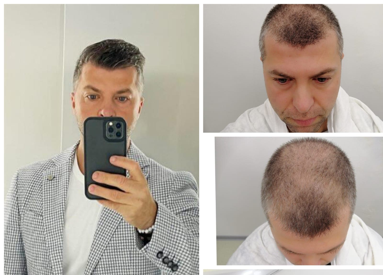 Saç ekimi öncesi ve sonrası — vaka 17