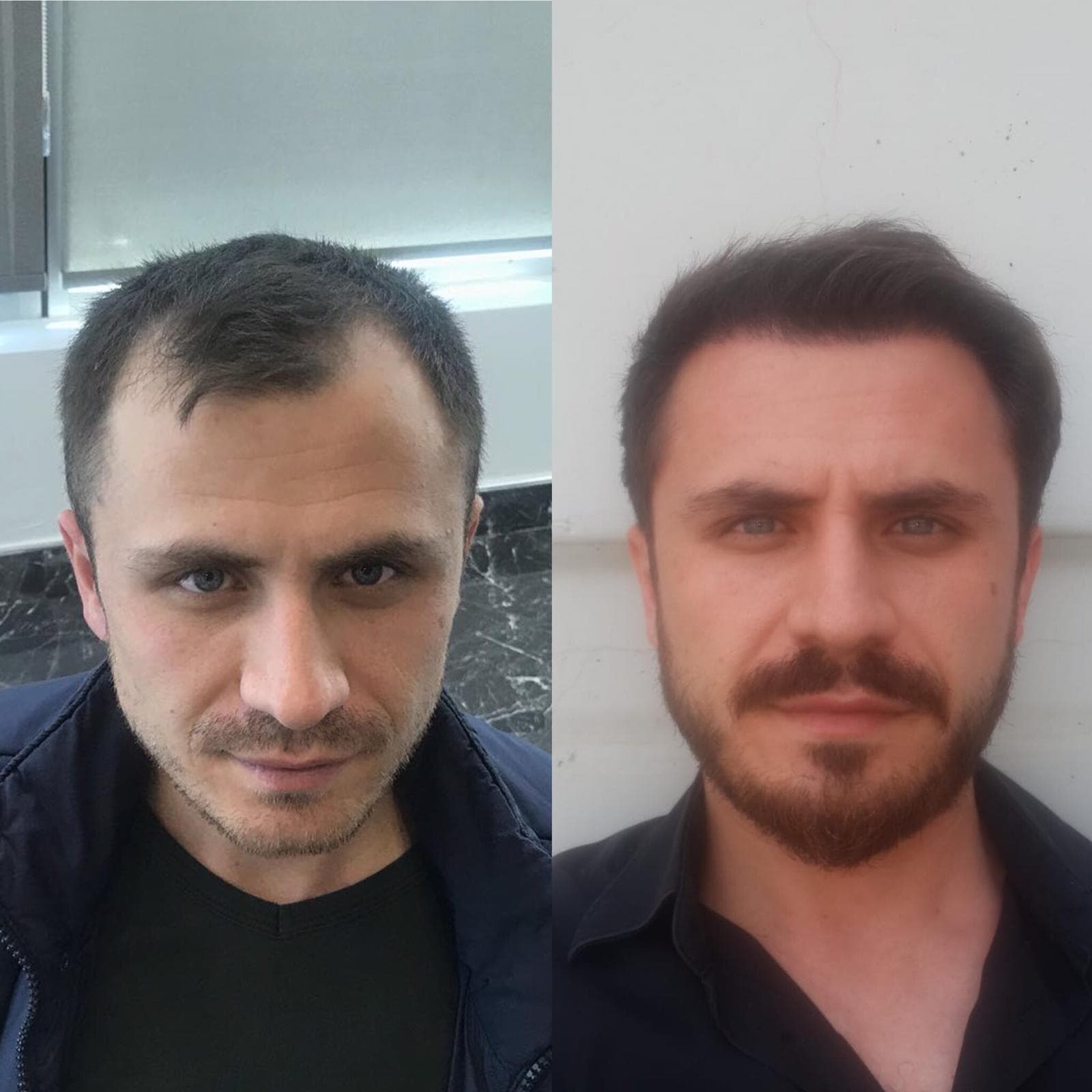 Saç ekimi öncesi ve sonrası — vaka 18