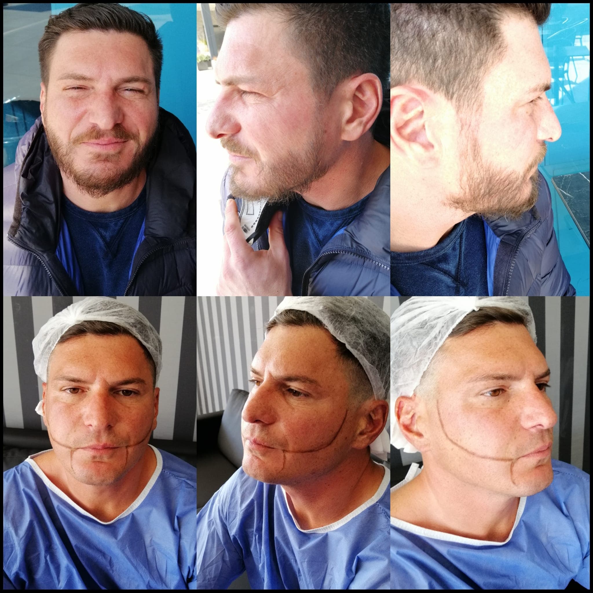 Saç ekimi öncesi ve sonrası — vaka 22