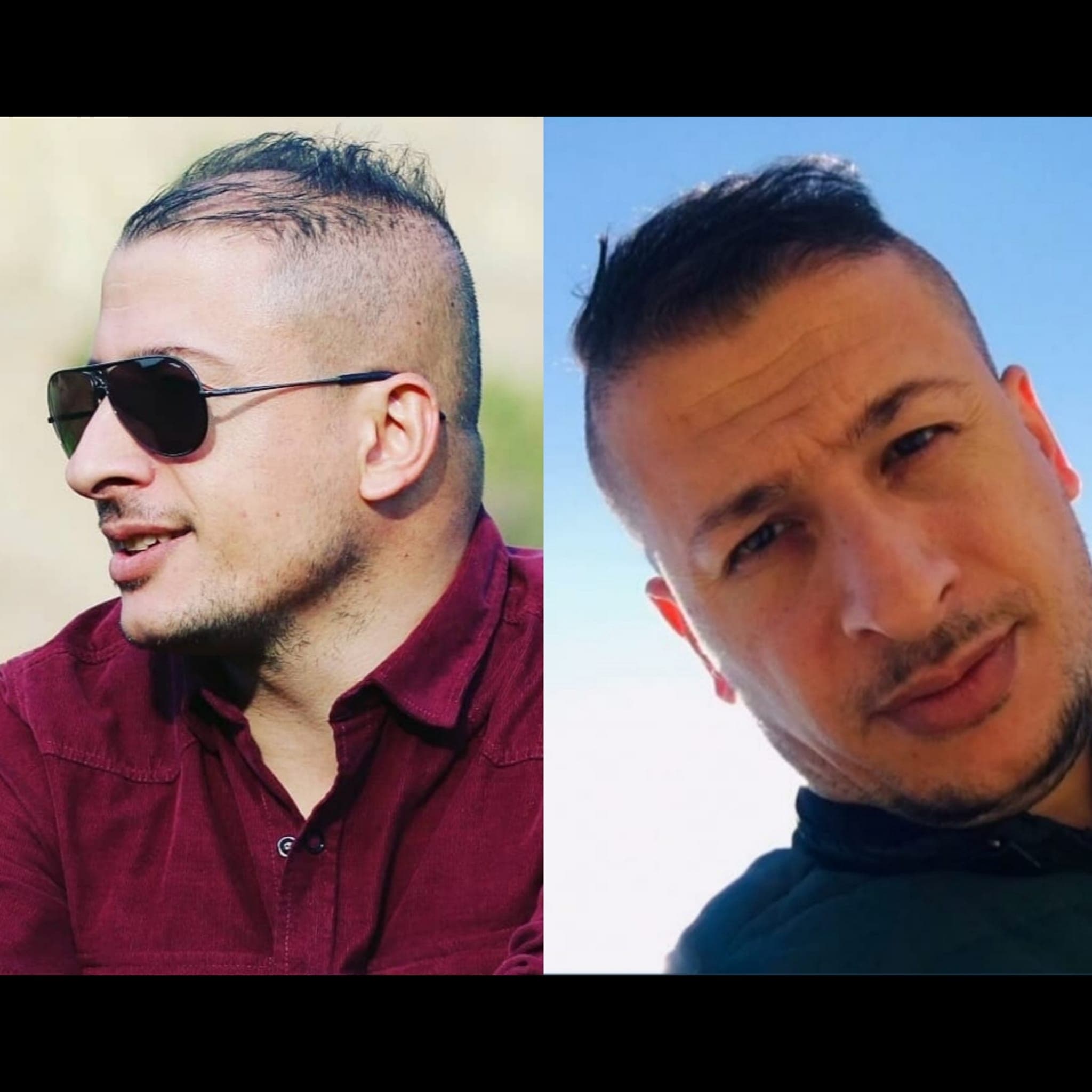 Saç ekimi öncesi ve sonrası — vaka 28