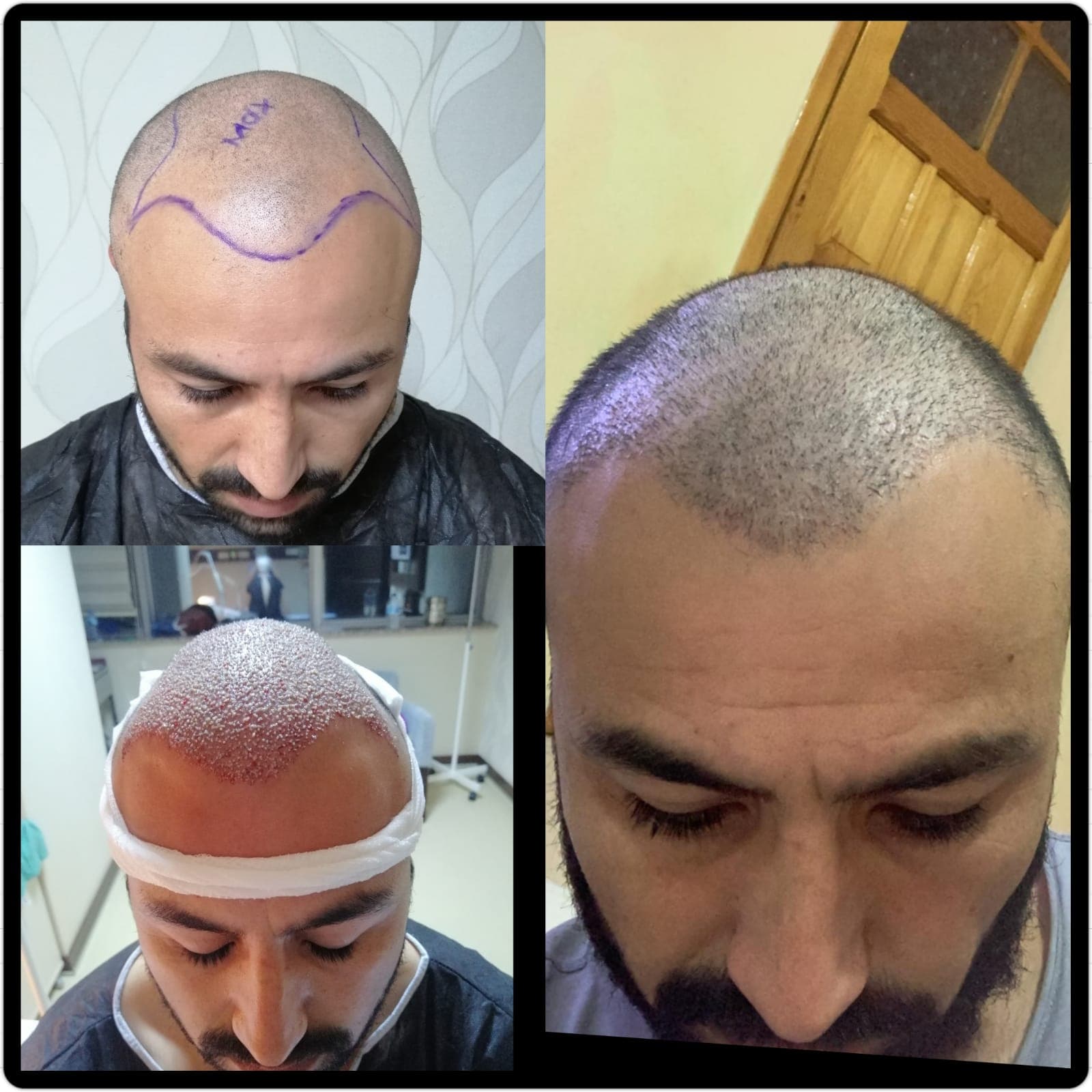 Saç ekimi öncesi ve sonrası — vaka 37