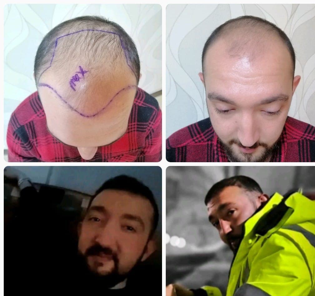 Saç ekimi öncesi ve sonrası — vaka 39
