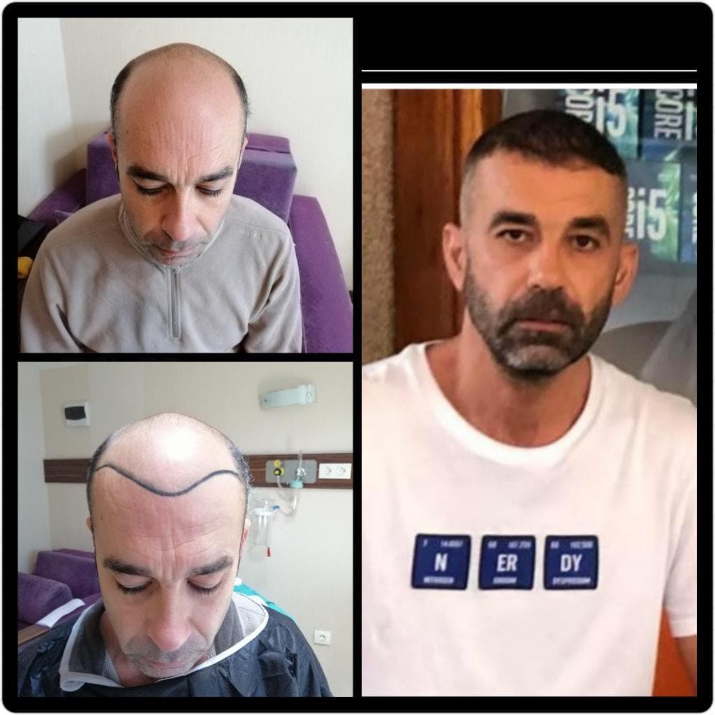 Saç ekimi öncesi ve sonrası — vaka 49