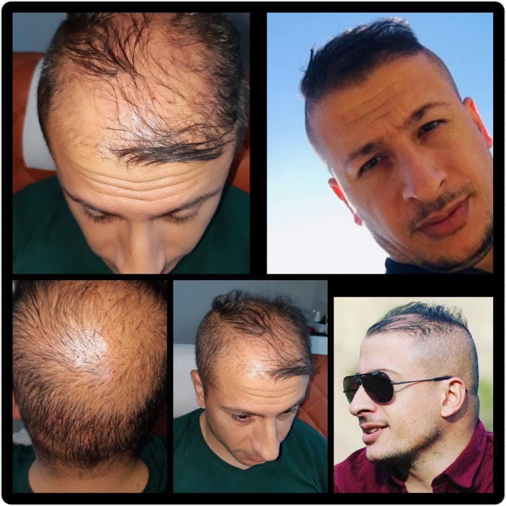 Saç ekimi öncesi ve sonrası — vaka 52