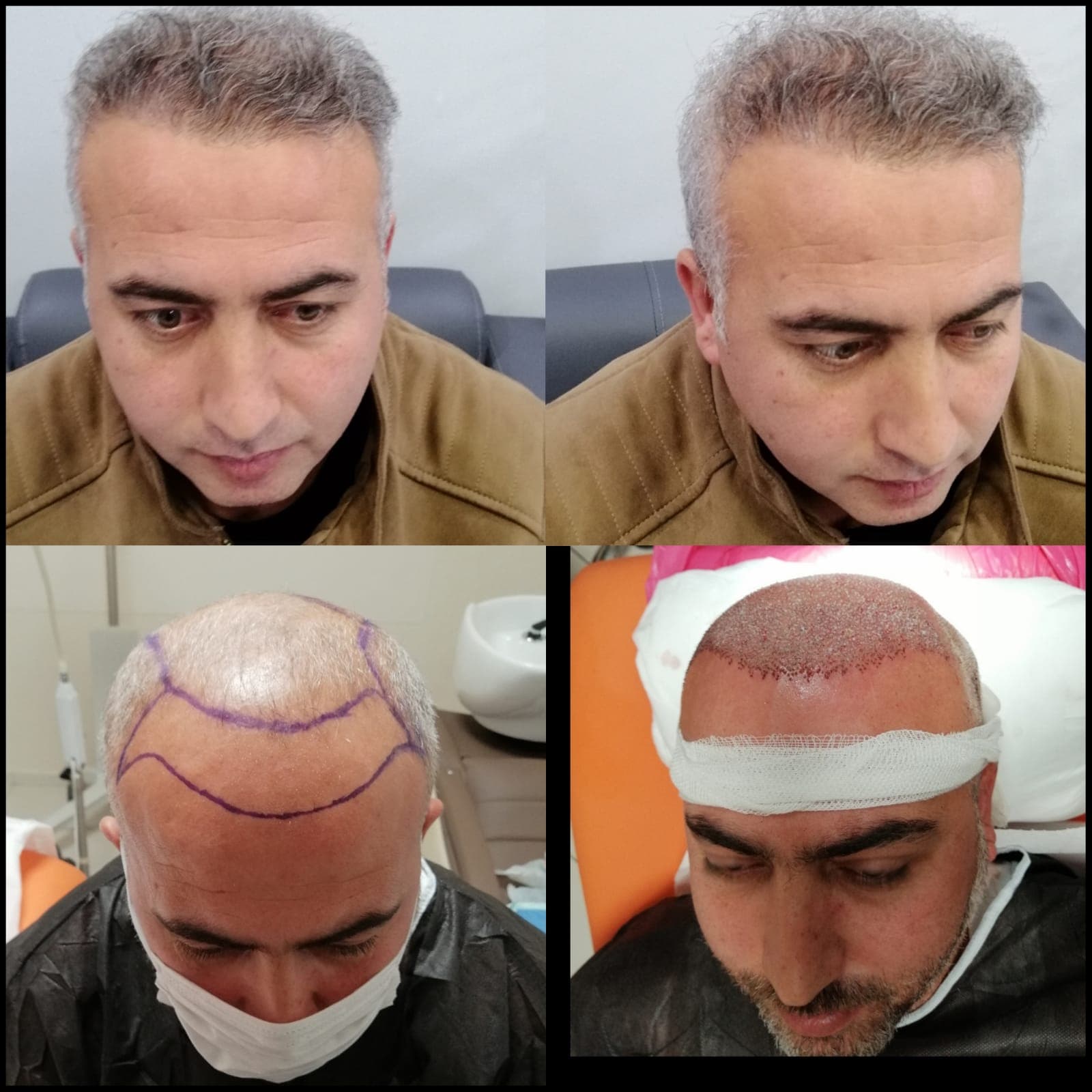 Saç ekimi öncesi ve sonrası — vaka 53