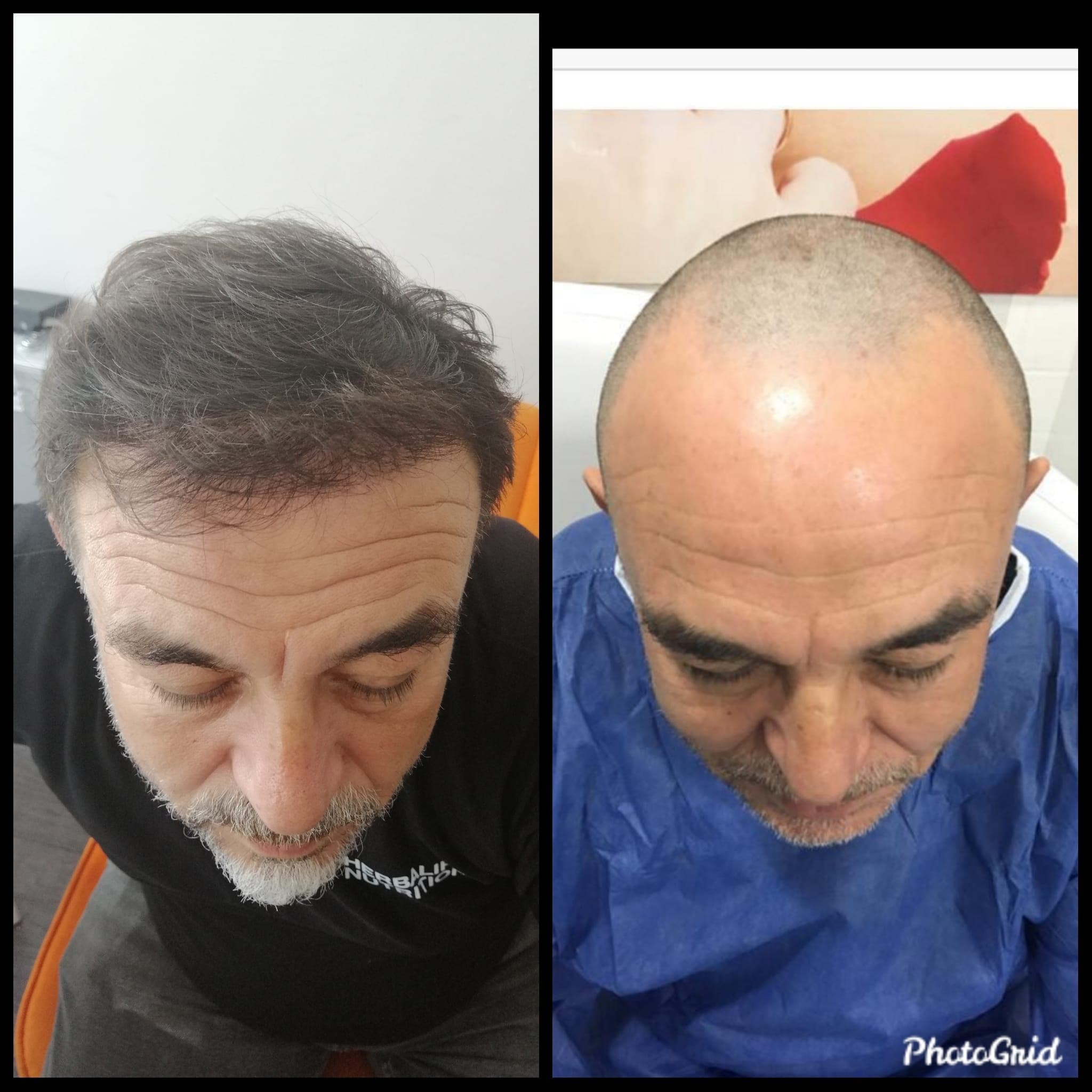 Saç ekimi öncesi ve sonrası — vaka 54
