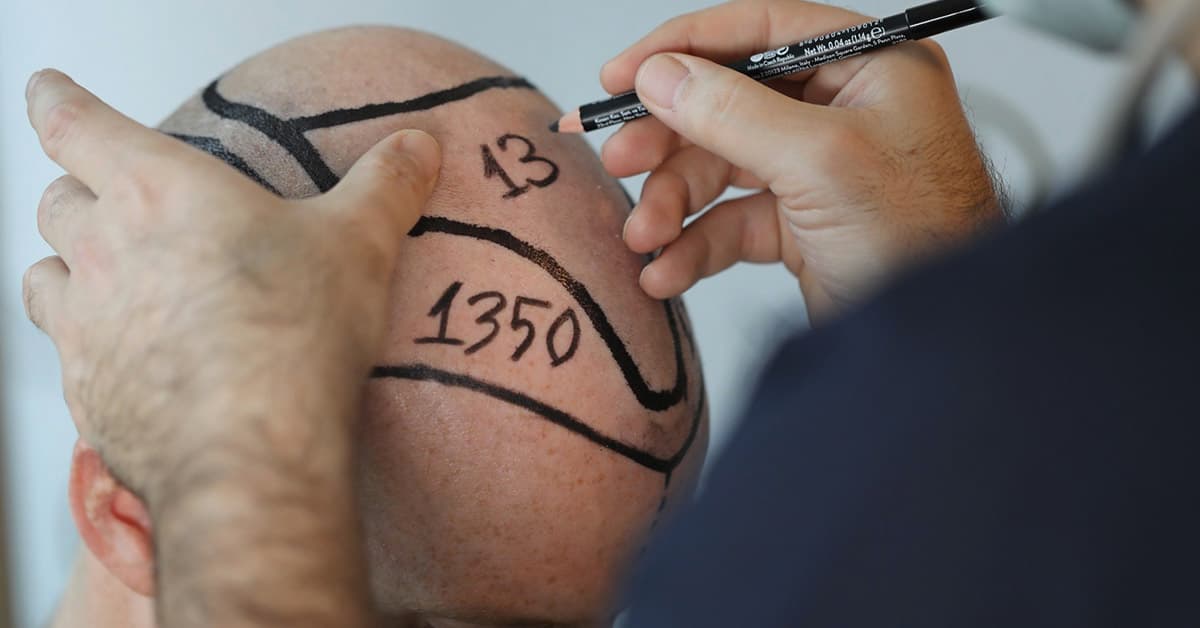 Greft Nedir? Greft Alma ve Ekim Süreci Hakkında Her Şey